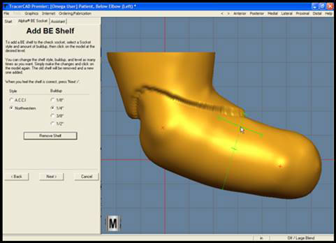 Upper Extremity Prosthetics in St. Louis