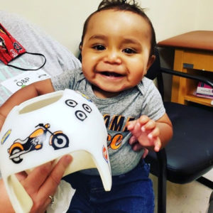 Baby Helmet Therapy