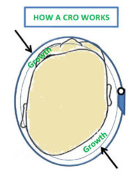 Baby Helmet Therapy with Cranial Orthotics