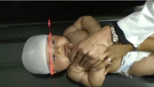 Baby Helmet Therapy